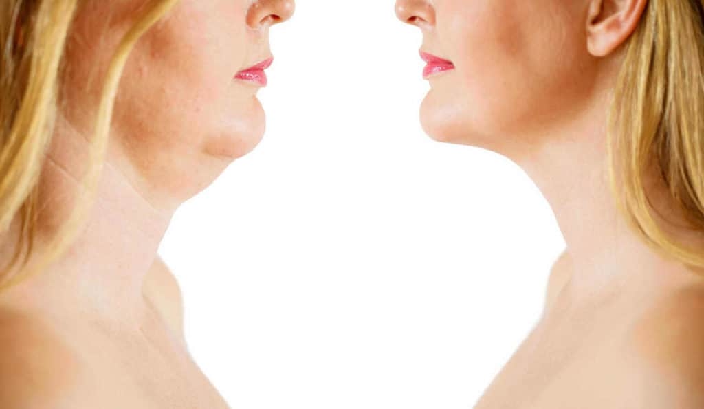 Double Chin treatment Greater London (Enfield) before and after results