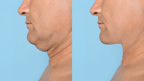 Which Non-Surgical Treatments Work Best for Jowls and Loose Skin Greater London (Enfield)?