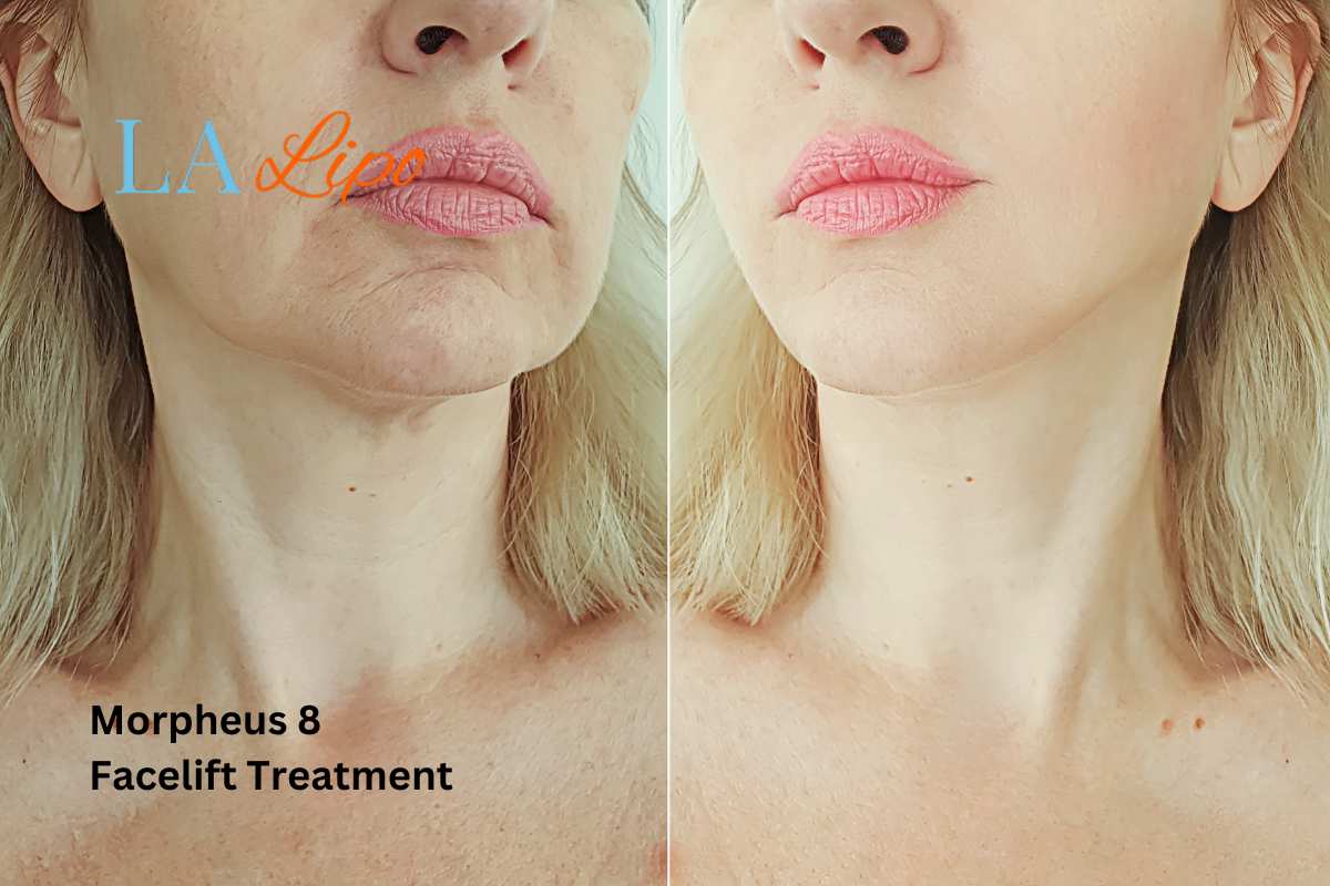 Turn back time with Morpheus8 Treatment Greater London (Enfield)