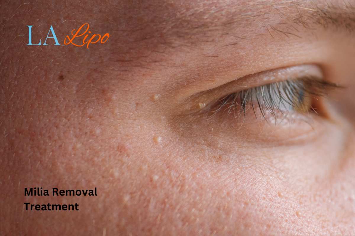 Cryopen Milia Removal: Is It the Easiest and Safest Option Greater London (Enfield)?