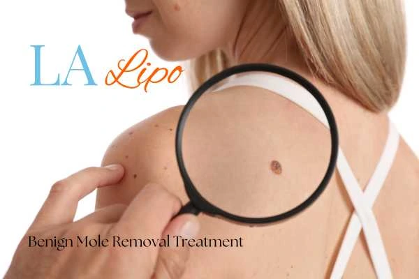 Why getting moles removed Greater London (Enfield) can boost your confidence!