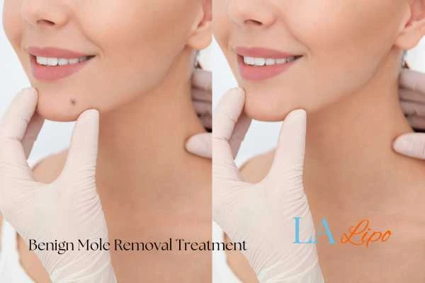 Woman's before and after results of being moles removal treatment Greater London (Enfield)