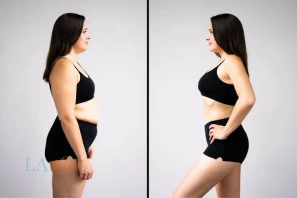 LA-EMS Body Sculpting Greater London (Enfield) results before and after of womans results on body toning.
