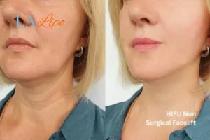 hi-fu for wrinkles Greater London (Enfield) before and after results