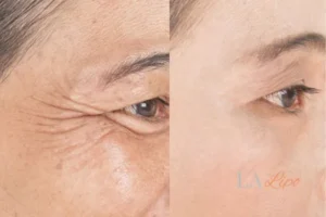 Before and after results of woman - HI-fu wrinkles reduction treatment Greater London (Enfield)
