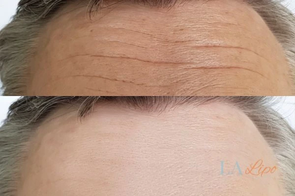 results of HIFU Greater London (Enfield) on mans forehead to help reduce lines and wrinkles