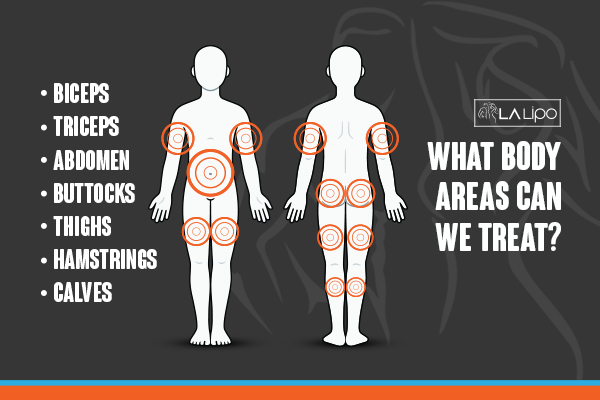 Graphic to show areas you can have LA-EMS Body Sculpting Greater London (Enfield) treatment.