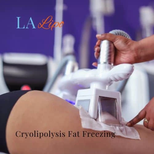 fat freezing - Cryolipolysis Greater London (Enfield)