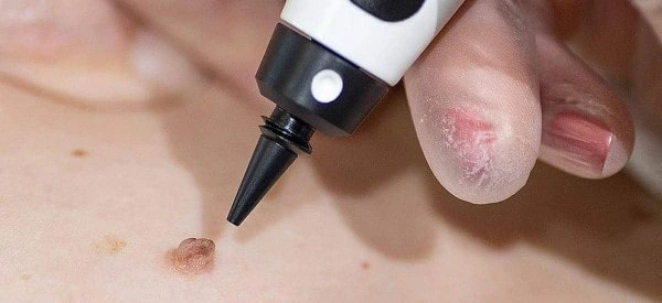 skin tag removal using cryopen Greater London (Enfield)