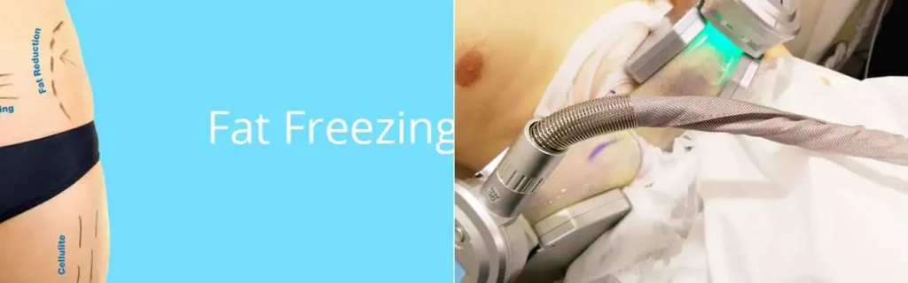 Fat freezing Greater London (Enfield) on multiple areas of the body