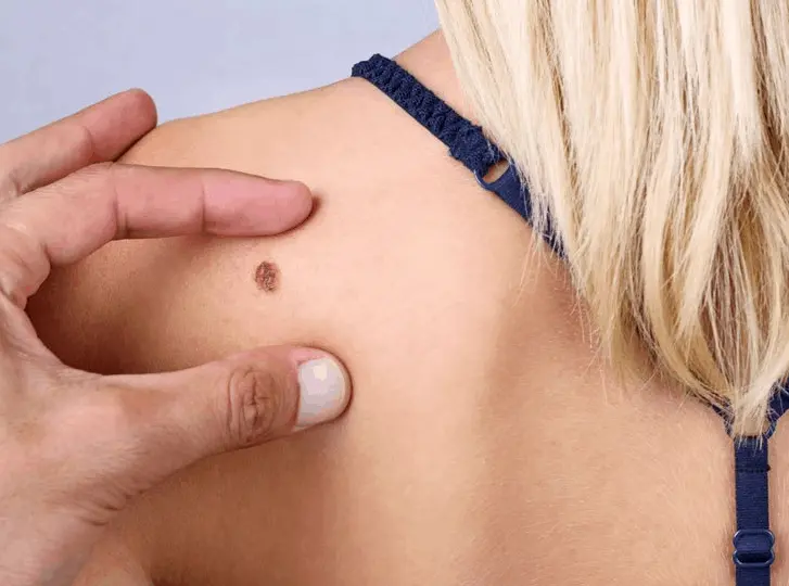 woman having mole removal Greater London (Enfield) consultation before treatment.