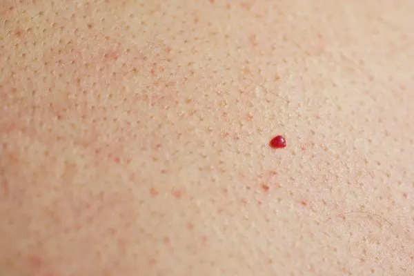 close up of a cherry angioma Greater London (Enfield)