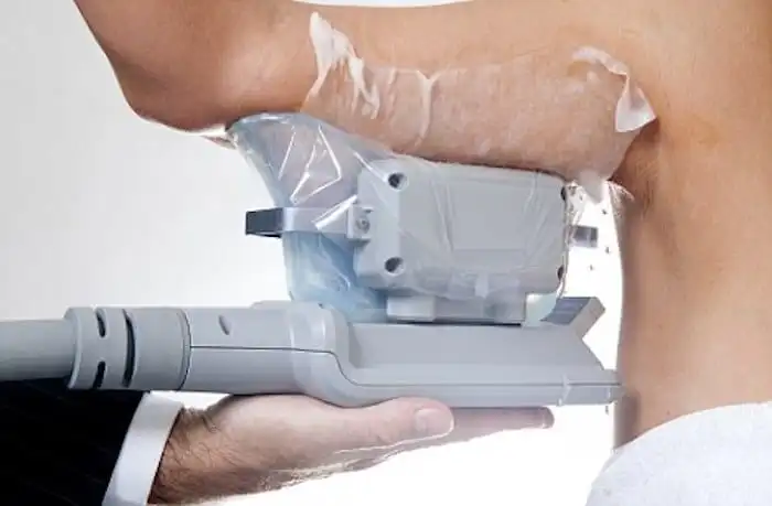 Picture of fat freezing Greater London (Enfield) on the upper arms.