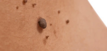 image of a skin tag Greater London (Enfield)