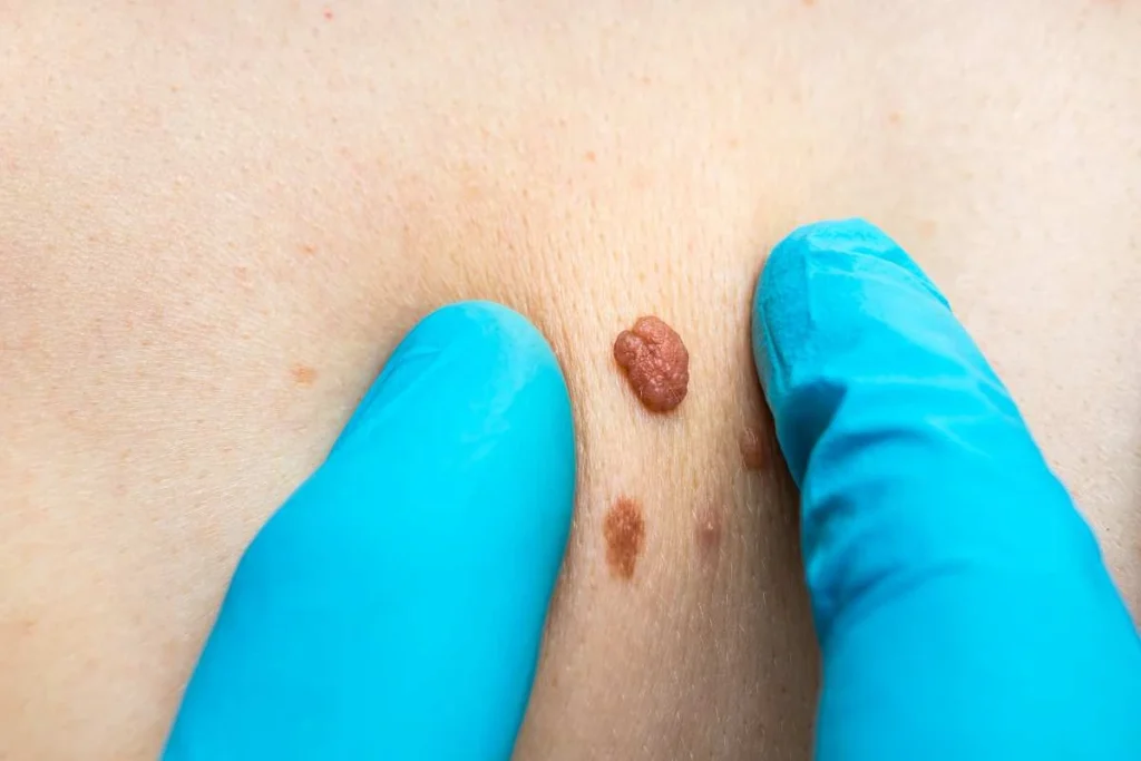 Consultant examining a skin tag Greater London (Enfield)