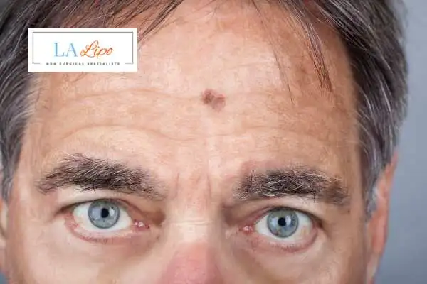 Solar Lentigo Removal Greater London (Enfield) image of man with mark on his forehead