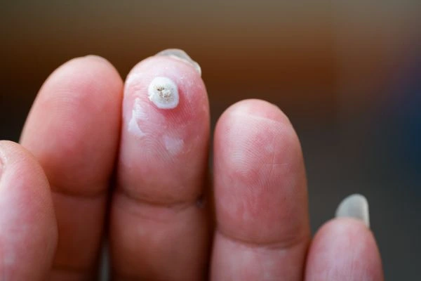 wart on person finger - cryotherapy to treat from LA LIPO Greater London (Enfield)