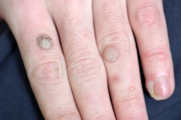 photo of warts on person hand - see wart removal Greater London (Enfield) from LA LIPO