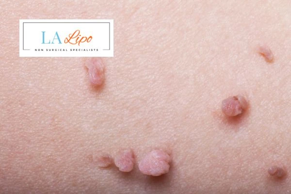 Does cryopen skin tag removal Greater London (Enfield) hurt? Find out now call our team today!