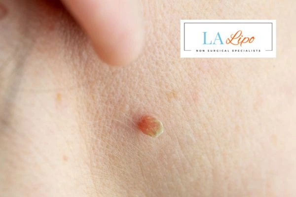 Book skin tag removal Greater London (Enfield) today speak to our team now!
