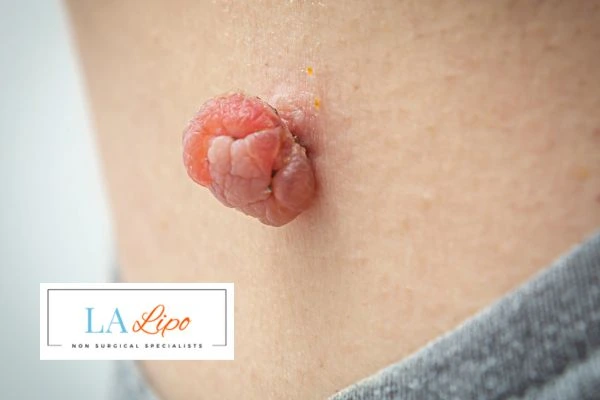 Interested in skin tag removal Greater London (Enfield)? Concerned about the pain? Find out more today!