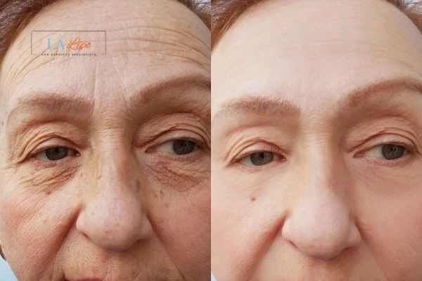 The powerful benefits of Morpheus8 Treatment Greater London (Enfield) - Call Our team today!