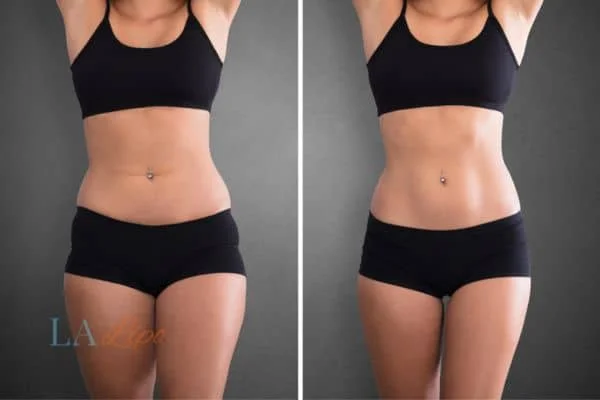 before and after results of non-surgical treatment to help a woman's body image and mental health Greater London (Enfield)