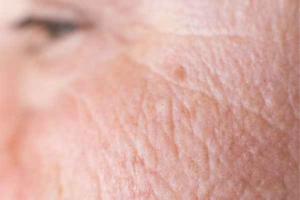 close up picture of a woman's face showing an age spot Greater London (Enfield)