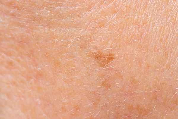 close up picture of age spots Greater London (Enfield)