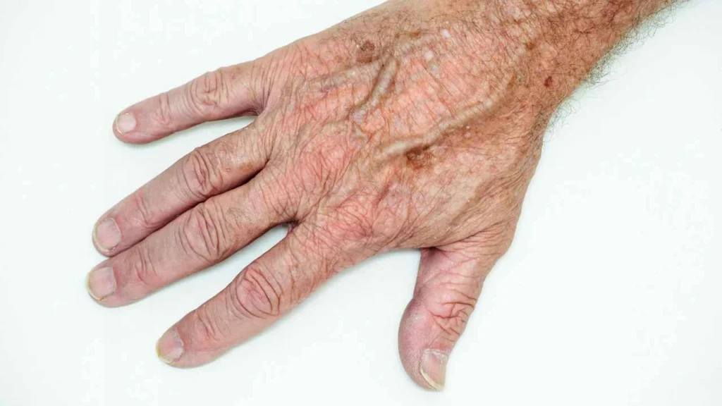 Male hand showing age spot Greater London (Enfield)