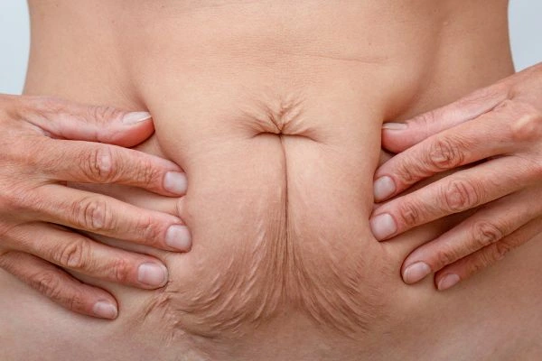 Image of a woman's stomach with loose skin - example of skin tightening Greater London (Enfield) options