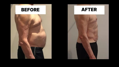 What Symptoms Can Diastasis Recti Cause in Men? Weak Core, Back Pain and Poor Posture Greater London (Enfield)